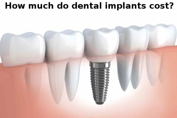 the-cost-of-dental-implants