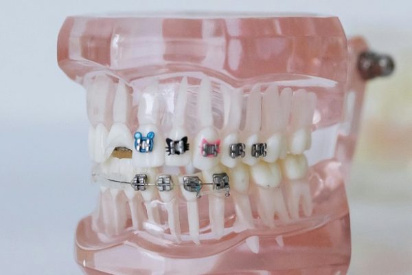 know more about braces cost in india for your dental treatment