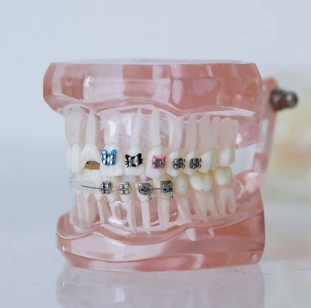 know more about braces cost in india for your dental treatment